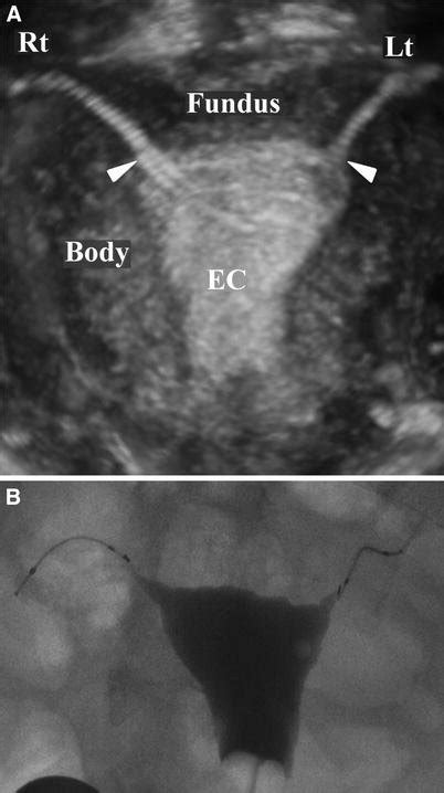 Essure Ultrasound