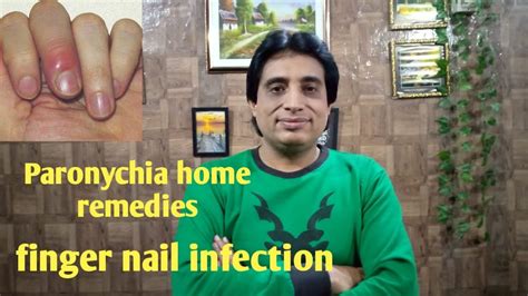 Paronychia home remedies I finger nail infection I skin infection - YouTube