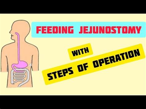 Feeding Jejunostomy | Steps of the procedure - YouTube