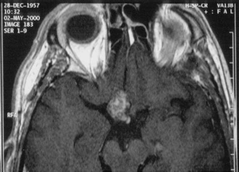 MRI scan showing the lesion in the region of the optic chiasm ...