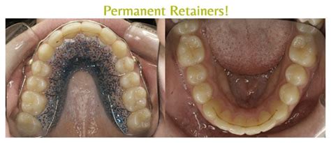 Permanent Retainer Libertyville IL Arpino Orthodontics Lake Bluff