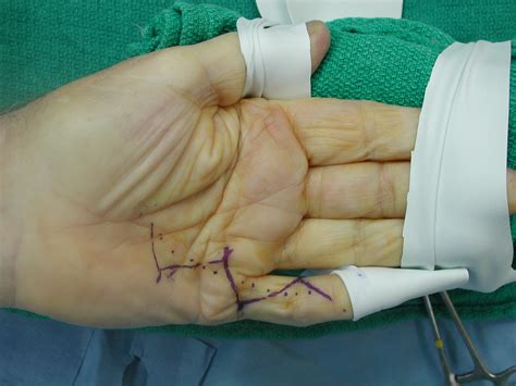 Dupuytren's: Palmar Fasciectomy Bruner Y-V flaps