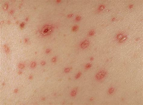 Maculopapular Rash - Definition, Pictures, Causes, Symptoms and Treatment