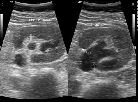 Pyonephrosis is a term given to infection of the renal pelvic system ...