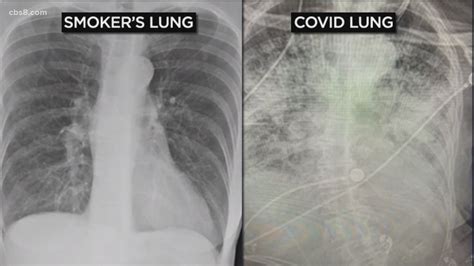 Are COVID-19 patient's lungs worse than smokers? | cbs8.com