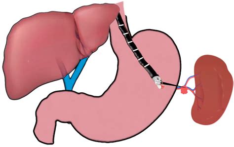 JCM | Free Full-Text | EUS-Guided Vascular Interventions