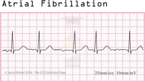 Atrial Fib Ecg Rhythm Strips