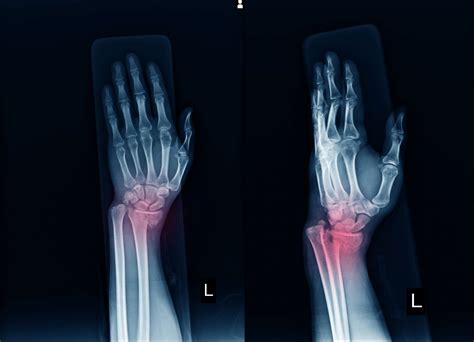 Wrist Fracture Treatment | Ladan Hajipour Orthopaedic Surgeon