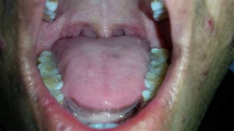 Tongue Fasciculation in MND - YouTube