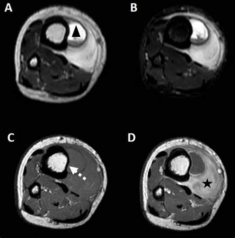 Ossifying Subperiosteal Hematoma Caused by a Plexiform Neurofibroma | Journal of the Belgian ...