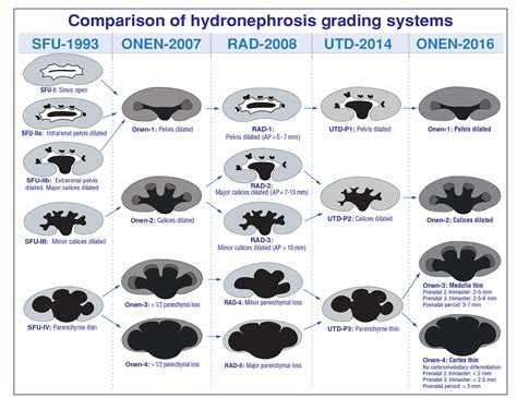 Grading System Hydronephrosis In Adults