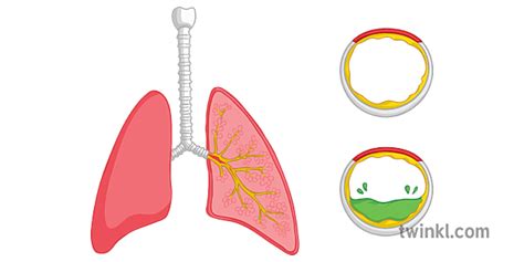 Cystic Fibrosis Lungs Mucus Diagram Unlabelled Genetic Genes Science