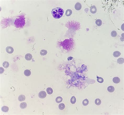 Pneumocystis Jirovecii