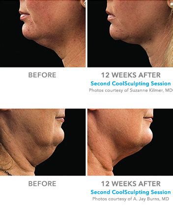 Coolsculpting Neck in Hudson Valley, NY