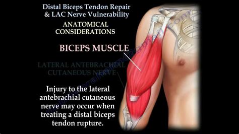 Distal Biceps Tendon Rupture Repair