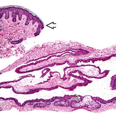 Steatocystoma Multiplex Histology