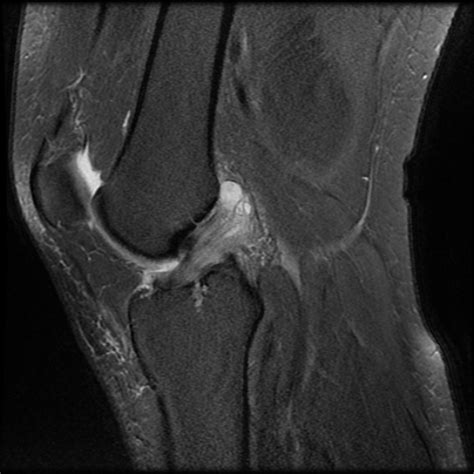 mucoid degeneration of acl treatment - speranzalindy