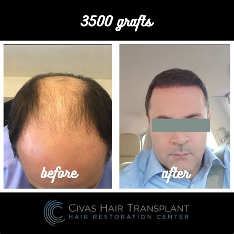 Dr. Ekrem Civas, MD - Before & Afters | IAHRS Member