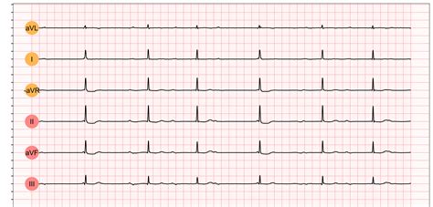 Third-degree AV block (3rd degree AV block, AV block 3, AV block III ...