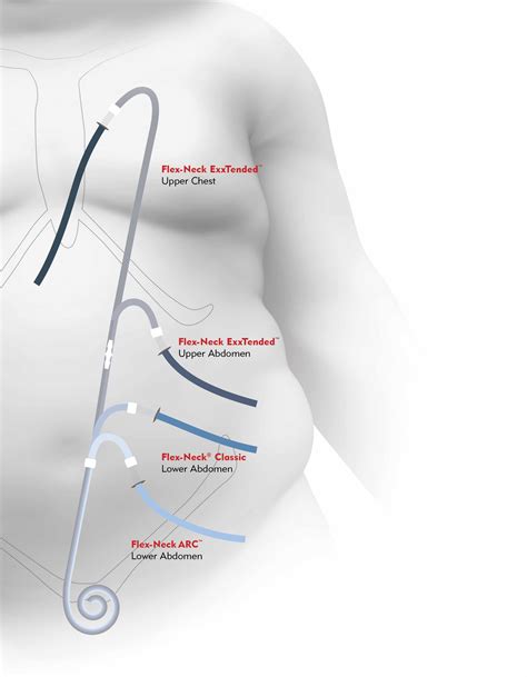 Peritoneal Catheter Placement