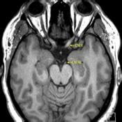 Trochlear Nerve Mri