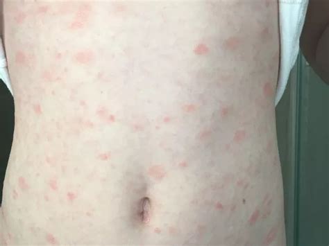 Experts show images of eight rash types that could be Covid symptom - LancsLive