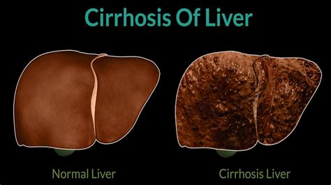 Liver Cirrhosis | Cirrhosis Symptoms | Treatment Of Liver | Causes of cirrhosis - YouTube