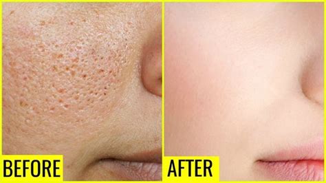 Three Pictures Compared Effect Before And After Treatment Skin With ...