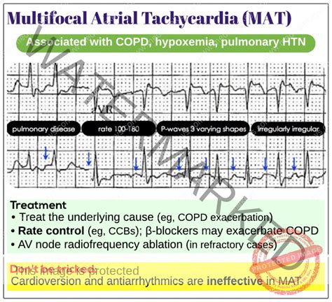 Multifocal atrial tachycardia (MAT) - Medicine Keys for MRCPs