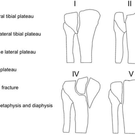 Schatzker Fracture Classification