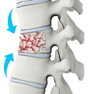 Spinal Compression Fractures | Advanced Orthopaedics & Sports Medicine ...