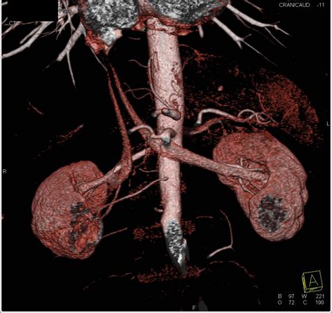 Renal Artery Stenosis - Vascular Case Studies - CTisus CT Scanning