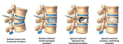 Kyphoplasty and Sacroplasty for Compression Fractures- Back Pain Treatment