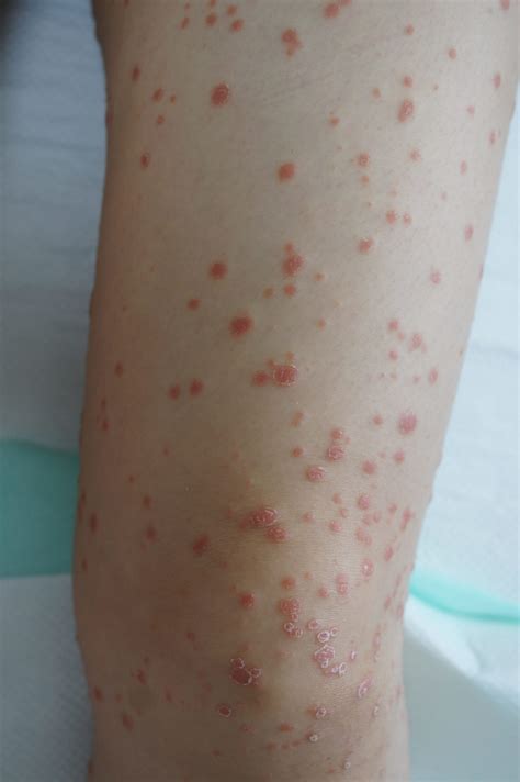 guttate psoriais on leg - Psoriasis Cure Now