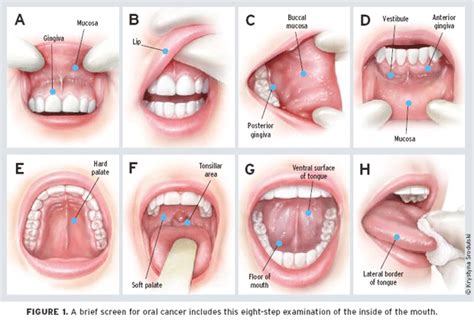 Oral Cancer: Symptoms, Causes, Treatments, and More