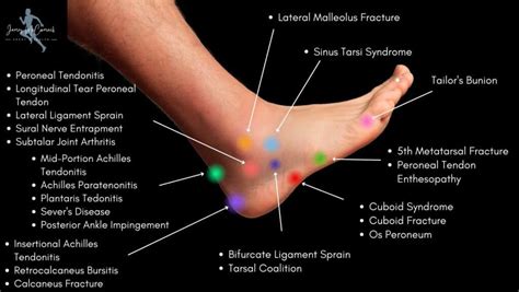 Foot Pain Chart: Top of Foot, Side and Front of Foot Pain Chart