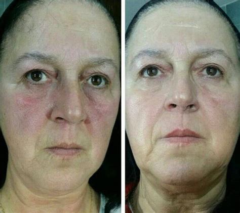 Phymatous Rosacea Early Symptoms » Rhinoplasty: Cost, Pics, Reviews, Q&A