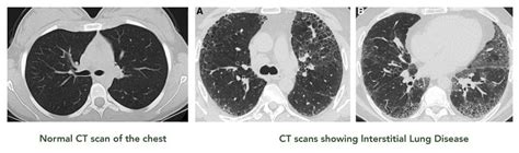 Interstitial Lung Disease (ILD) in Singapore - Dr Akash Verma