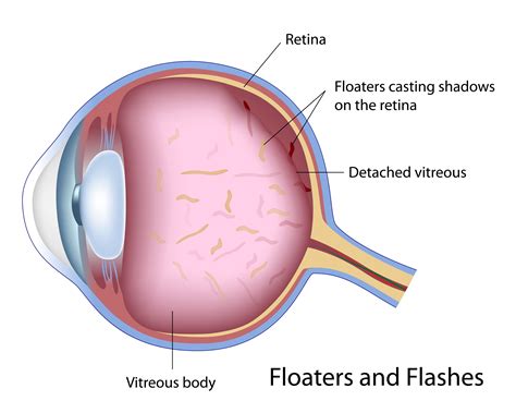 Laser Surgery for Retinal Detachment - Monterey, CA - Salinas - King City