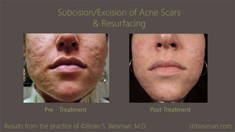 Acne Scar Treatment - Brian Biesman MD | Nashville, TN