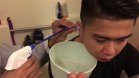 How To Remove Giant Ear Wax Removal at Home Easily - YouTube