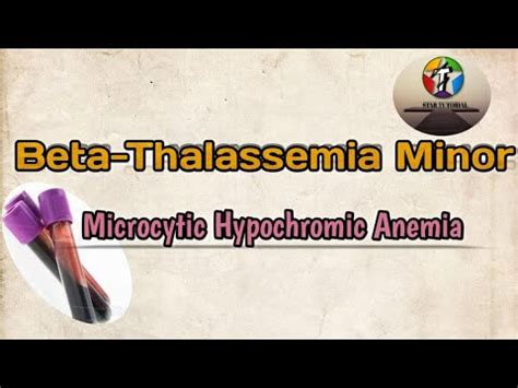 Beta-Thalassemia Minor ll Microcytic Hypochromic Anemia ll Hematology ...