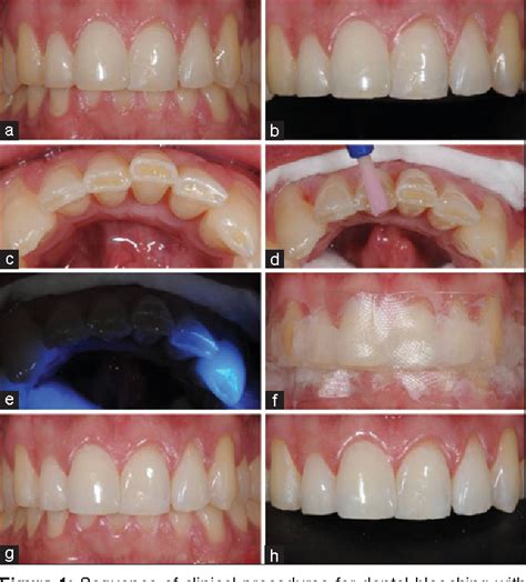 Hydrogen Peroxide Teeth Before And After