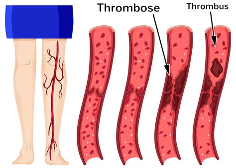 Thrombose - Thrombose Achten Sie Auf Diese Symptome Bildderfrau De / Bei der arteriellen ...