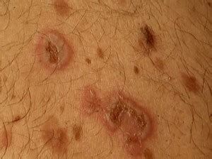 👉 Pemphigus Vulgaris - Pictures, Symptoms, Causes, Diagnosis, Treatment ...