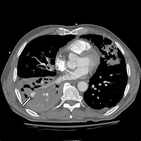 Hemoptysis