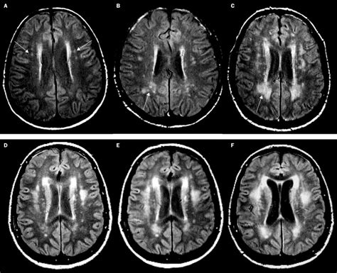 Progression of cerebral white matter lesions: 6-year results of the Austrian Stroke Prevention ...