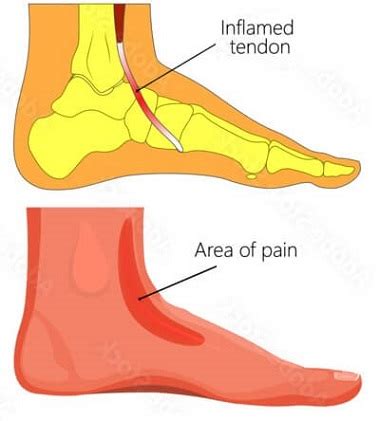 Tibialis Anterior Tendonitis: Causes & Treatment