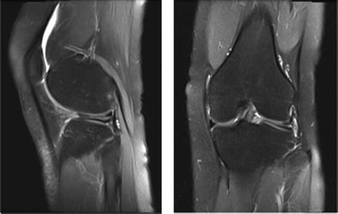 MRI demonstrates a horizontal discoid lateral meniscus tear | Download Scientific Diagram