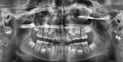 Dental X-rays: Why are they necessary at an orthodontic visit?